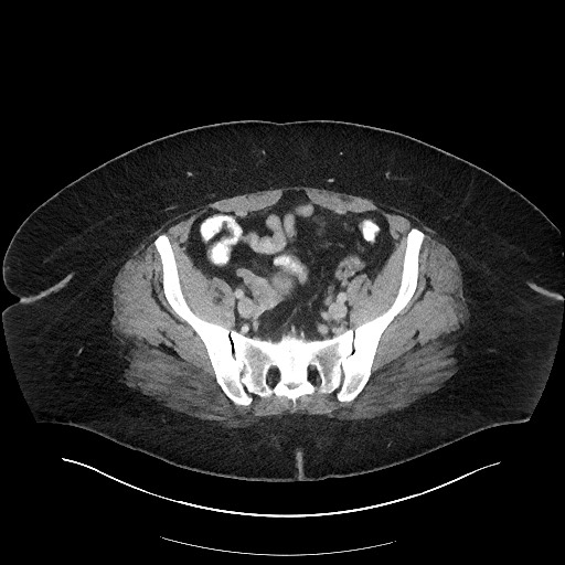 Carcinoid tumor - terminal ileum (Radiopaedia 60931-68739 A 103).jpg