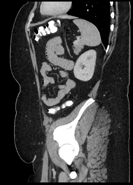 Carcinoid tumor - terminal ileum (Radiopaedia 60931-68739 C 18).jpg