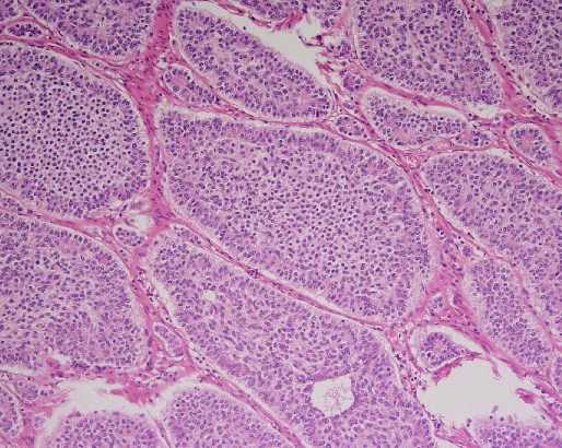 File:Carcinoid tumor of the ileum with metastasis to orbit (Radiopaedia 28165-28427 H&E 1).jpg