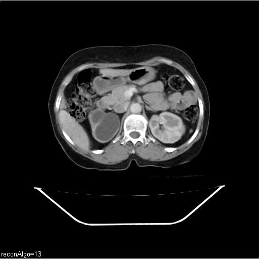 File:Carcinoma cervix- recurrence (Radiopaedia 34702-36137 B 17).jpg