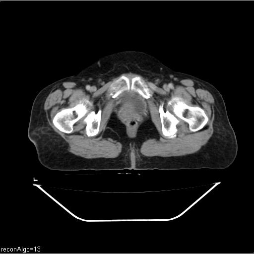 Carcinoma cervix- recurrence (Radiopaedia 34702-36137 B 52).jpg