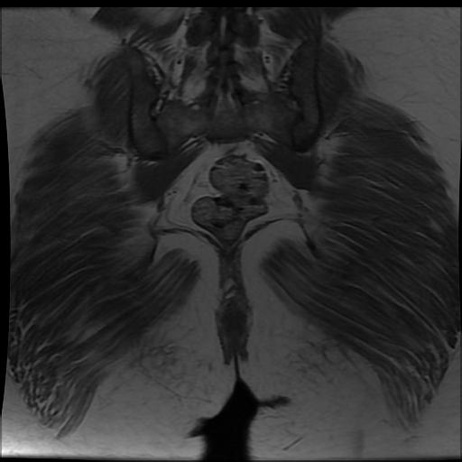File:Carcinoma of the cervix (Radiopaedia 89018-105858 Coronal T1 15).jpg
