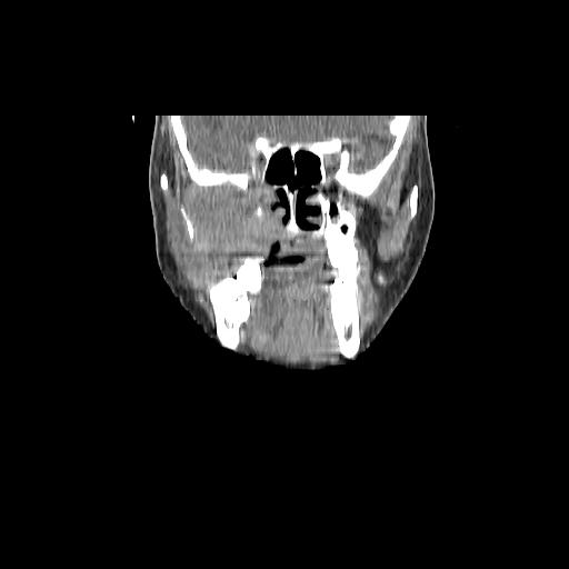 Carcinoma of the maxillary antrum (Radiopaedia 53805-59888 Coronal C+ delayed 54).jpg
