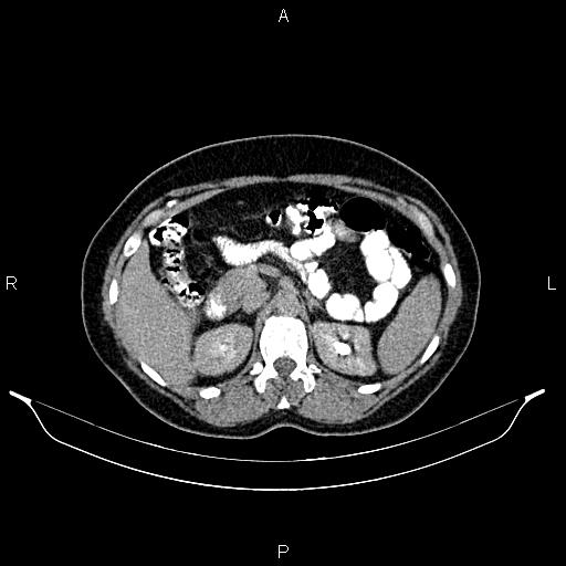 File:Carcinoma of uterine cervix (Radiopaedia 85861-101700 Axial C+ delayed 18).jpg