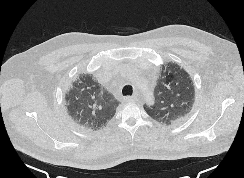 Cardiogenic pulmonary edema (Radiopaedia 68180-77678 Axial lung window 15).jpg