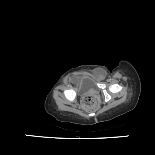 File:Caroli disease with autosomal recessive polycystic kidney disease (ARPKD) (Radiopaedia 89651-106703 B 215).jpg
