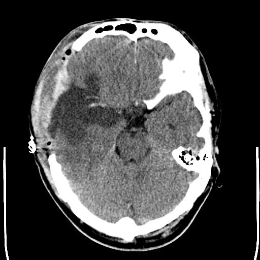 File:Carotid arterial dissection (Radiopaedia 30001-30548 Axial non-contrast 9).jpg