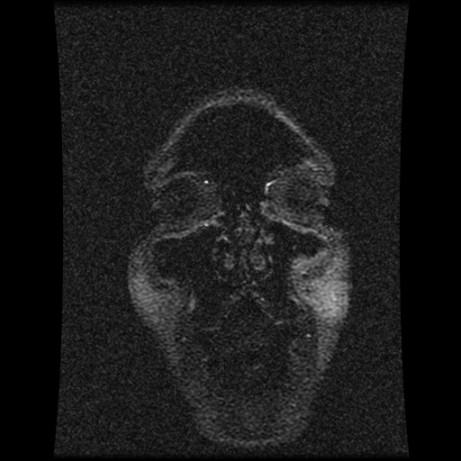 Carotid arterial dissection with acute cerebral infarction (Radiopaedia 26636-26784 MRV 147).jpg