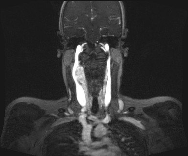 Carotid body tumor (Radiopaedia 12777-12912 MRA 37).jpg