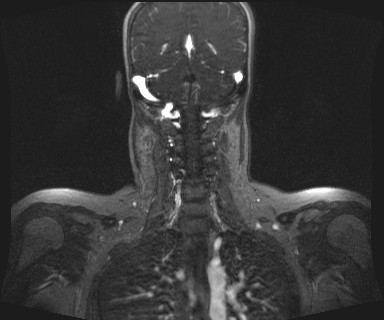 Carotid body tumor (Radiopaedia 12777-12912 MRA 51).jpg