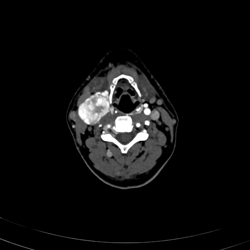 Carotid body tumor (Radiopaedia 83615-98727 A 60).jpg