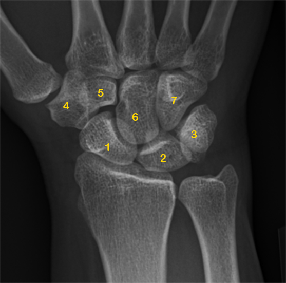 File:Carpal bones - annotated x-ray (Radiopaedia 43806).jpg