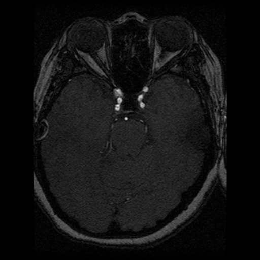 Cavernoma, DVA and right ICA aneurysm (Radiopaedia 33890-35072 E 59).png