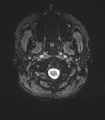 File:Cavernoma with bleed - midbrain (Radiopaedia 54546-60773 Axial SWI 1).png