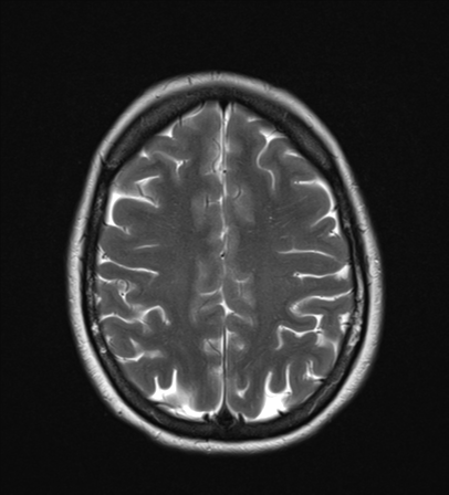 File:Cavernoma with bleed - midbrain (Radiopaedia 54546-60774 Axial T2 21).png