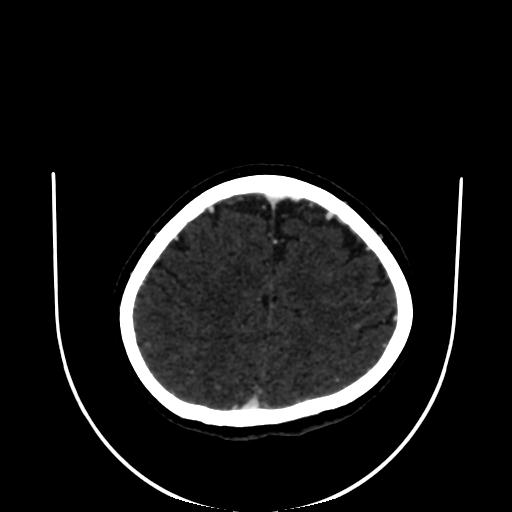 Cavernoma with developmental venous anomaly (Radiopaedia 22470-22506 C 156).jpg