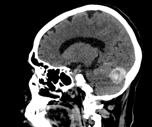 Cavernous hemangioma of the cerebellar falx (Radiopaedia 73025-83723 B 195).jpg