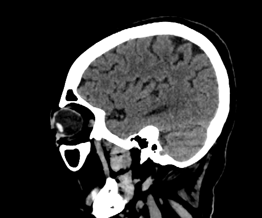 Cavernous hemangioma of the cerebellar falx (Radiopaedia 73025-83723 B 246).jpg