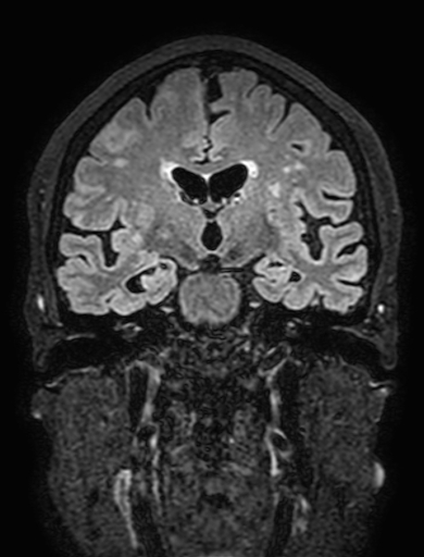 Cavernous hemangioma of the cerebellar falx (Radiopaedia 73025-83724 Coronal FLAIR 170).jpg