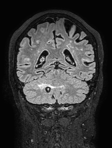 Cavernous hemangioma of the cerebellar falx (Radiopaedia 73025-83724 Coronal FLAIR 247).jpg