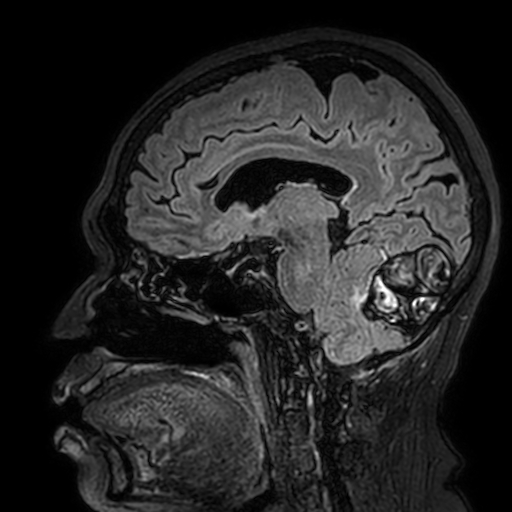 File:Cavernous hemangioma of the cerebellar falx (Radiopaedia 73025-83724 Sagittal FLAIR 121).jpg