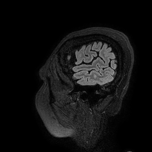 Cavernous hemangioma of the cerebellar falx (Radiopaedia 73025-83724 Sagittal FLAIR 203).jpg