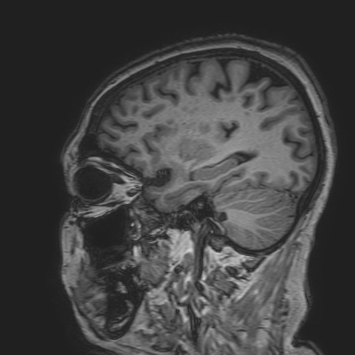File:Cavernous hemangioma of the cerebellar falx (Radiopaedia 73025-83724 Sagittal T1 62).jpg