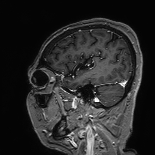 Cavernous hemangioma of the cerebellar falx (Radiopaedia 73025-83724 Sagittal T1 C+ 47).jpg