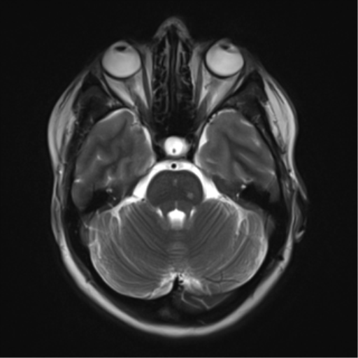 File:Cavernous malformation (cavernous angioma or cavernoma) (Radiopaedia 36675-38237 Axial T2 6).png