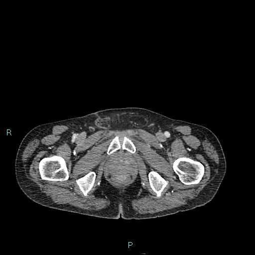 Cecal bascule (Radiopaedia 85770-101586 C 109).jpg
