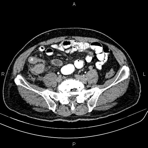File:Cecal cancer with appendiceal mucocele (Radiopaedia 91080-108651 Axial C+ delayed 54).jpg