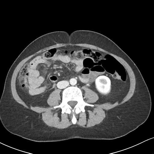 Cecal internal hernia through the foramen of Winslow (Radiopaedia 44820-48651 B 42).png