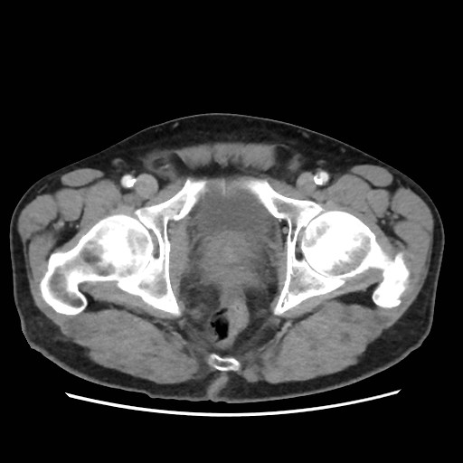 Cecal mass causing appendicitis (Radiopaedia 59207-66531 A 85).jpg