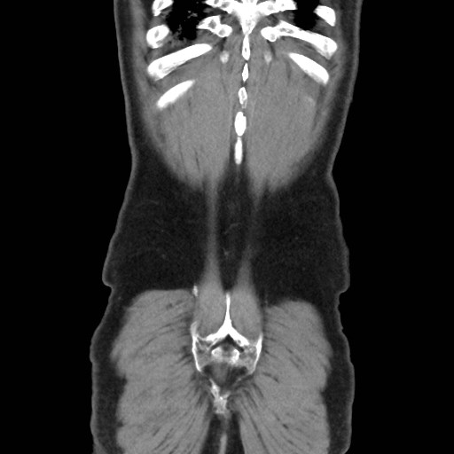 Cecal mass causing appendicitis (Radiopaedia 59207-66531 B 49).jpg