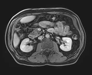 Cecal mass causing appendicitis (Radiopaedia 59207-66532 J 60).jpg