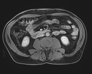 Cecal mass causing appendicitis (Radiopaedia 59207-66532 J 74).jpg