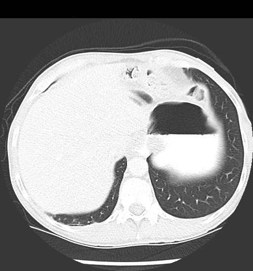 File:Cecal volvulus (Radiopaedia 48543-53513 Axial lung window 14).jpg