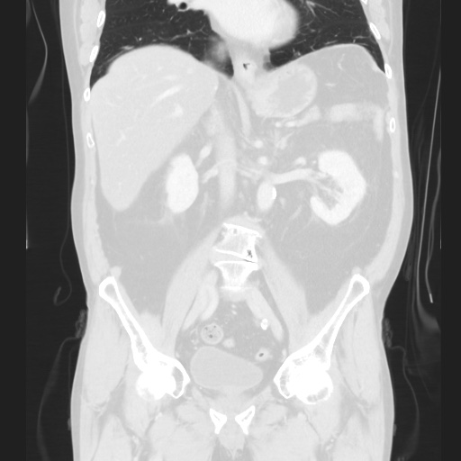 Cecal volvulus (Radiopaedia 75378-86620 Coronal lung window 80).jpg