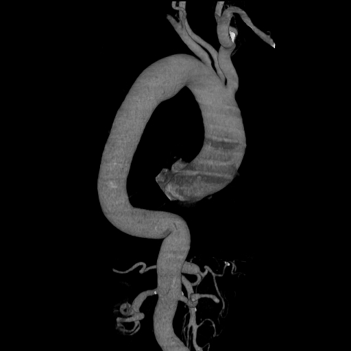 File:Celiac artery aneurysm (Radiopaedia 21574-21525 C 12).JPEG