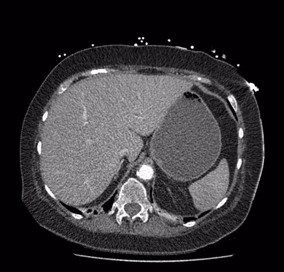 File:Celiac artery severe stenosis and dissection (Radiopaedia 44128-47842 B 14).jpg
