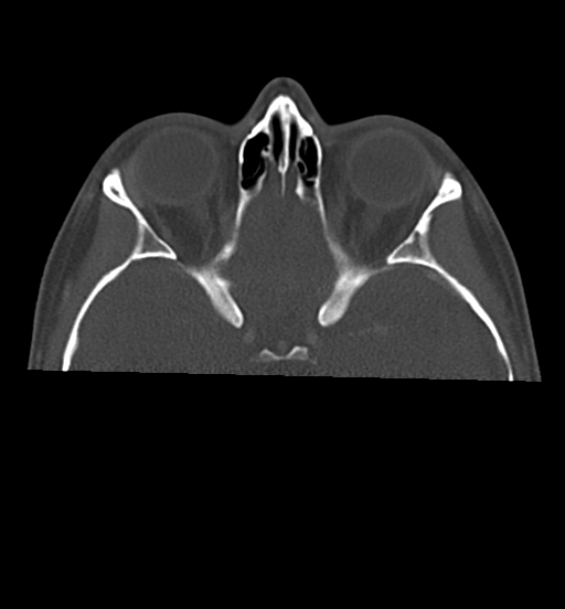 Cemento-ossifying fibroma (Radiopaedia 46243-50643 Axial bone window 16).png