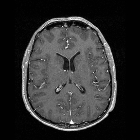 Central-variant posterior reversible encephalopathy syndrome (PRES) (Radiopaedia 43880-47358 Axial T1 C+ 95).jpg