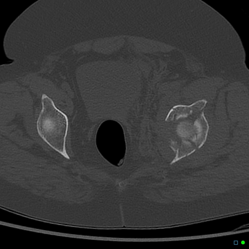 Central fracture-dislocation of the acetabulum (Radiopaedia 36578-38150 Axial bone window 53).jpg