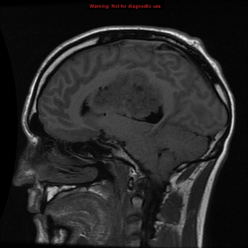 File:Central neurocytoma (Radiopaedia 13188-13206 Sagittal T1 7).jpg