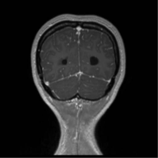 Central neurocytoma (Radiopaedia 37664-39557 Coronal T1 C+ 13).png