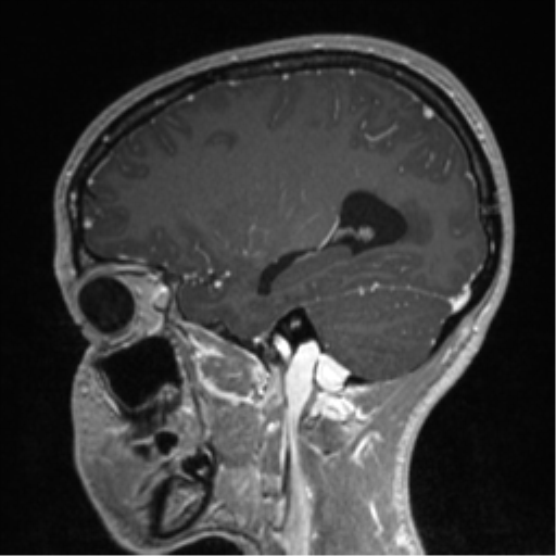 Central neurocytoma (Radiopaedia 37664-39557 Sagittal T1 C+ 67).png