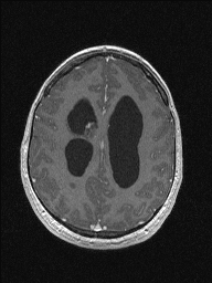 Central neurocytoma (Radiopaedia 56690-63469 Axial T1 C+ 120).jpg