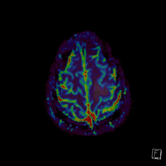 File:Central neurocytoma (Radiopaedia 84497-99872 Axial Perfusion 40).jpg