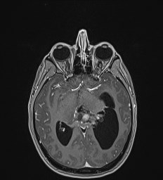 Central neurocytoma (Radiopaedia 84497-99872 Axial T1 C+ 70).jpg