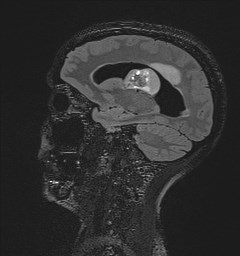 Central neurocytoma (Radiopaedia 84497-99872 Sagittal Flair + Gd 58).jpg